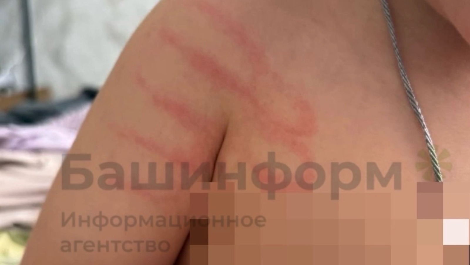 В Башкирии у ребенка после посещения детсада появились следы побоев